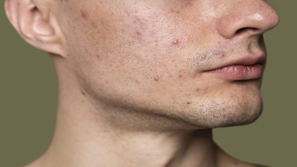 Differnce between acne and pimple