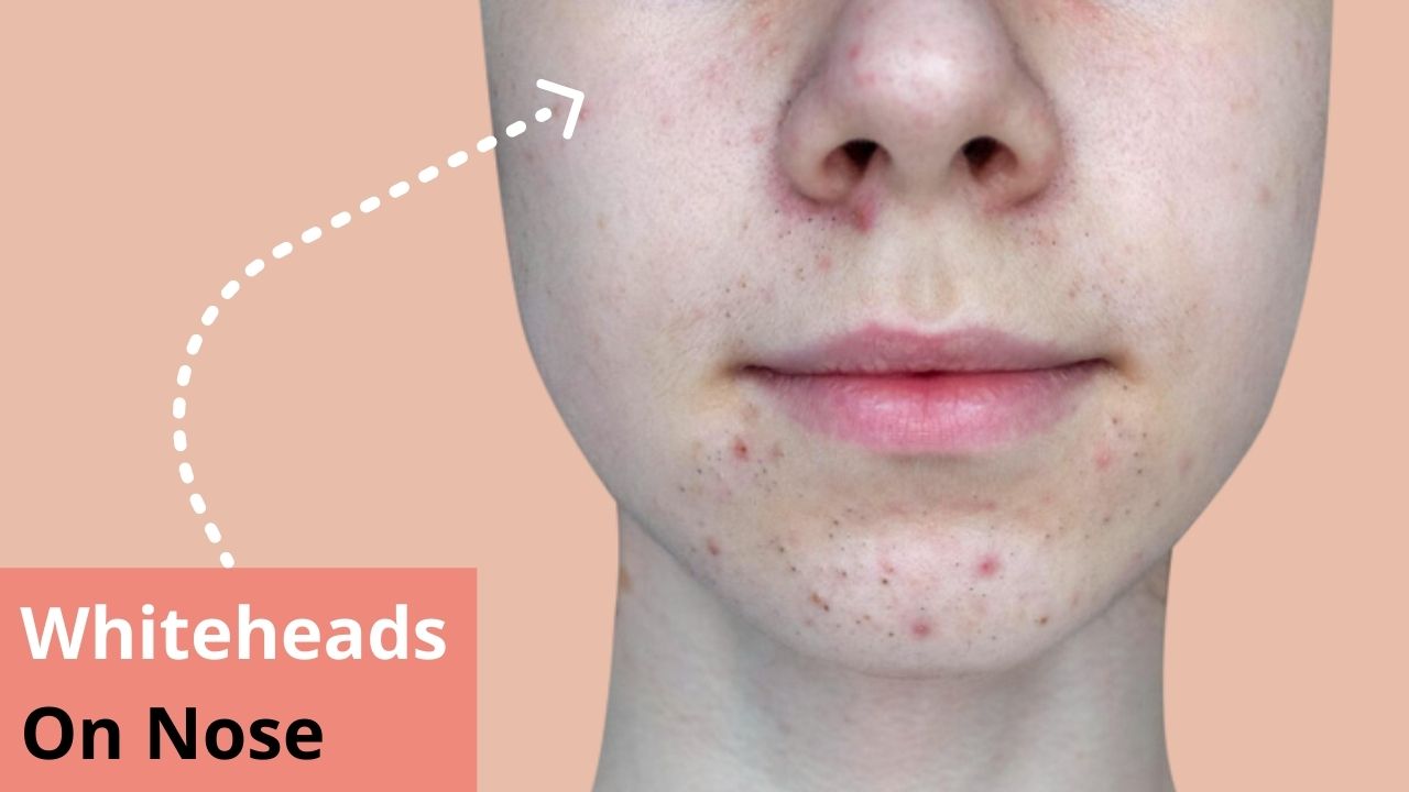 How To Get Rid Of Whiteheads On Nose? - Urban Skin And Hair Clinic