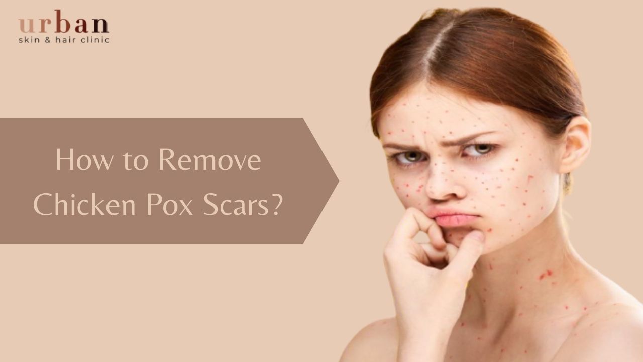 How to Remove Chicken Pox Scars? - Urban Skin and Hair Clinic