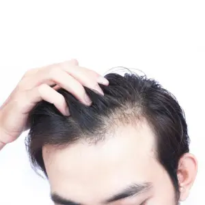 hairloss treatment