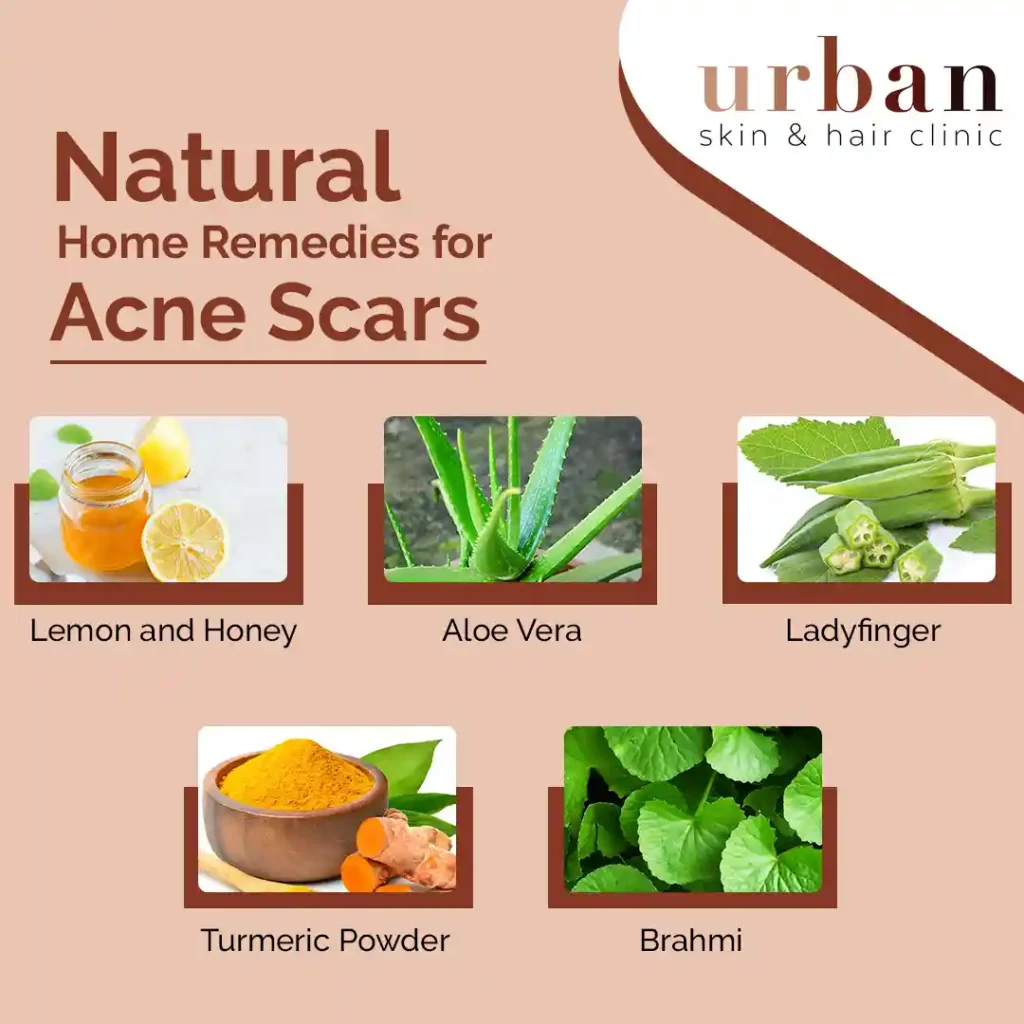 Natural Home Remedies for Acne Scars.