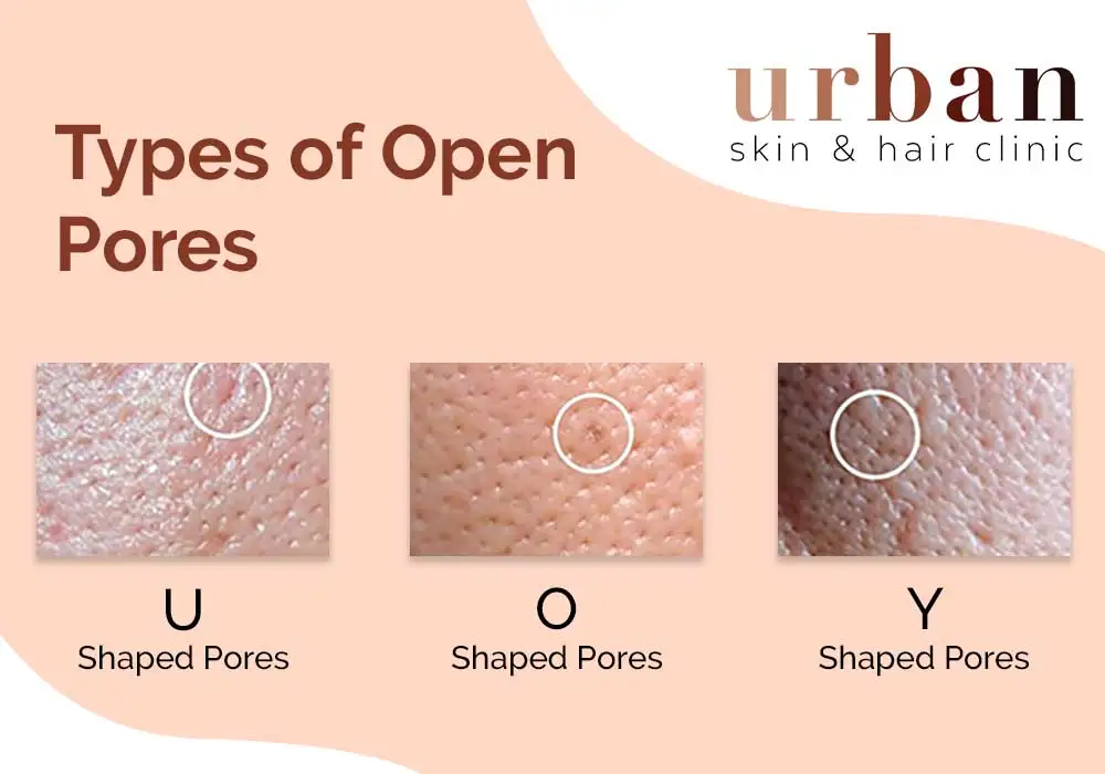 Open Pores Types Causes Symptoms And Treatment