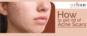 this is a featured image of how to get rid of acne scars - by Urban Skin and Hair clinic