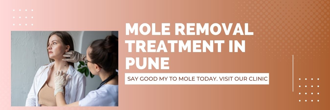 Mole Removal Treatment in pune