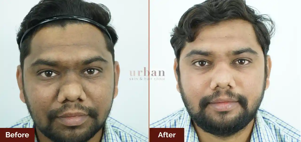 Homes 17 pigmentation treatment in male