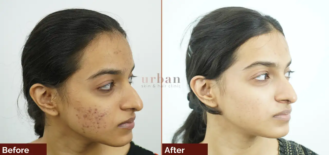 Homes 15 Female acne treatment