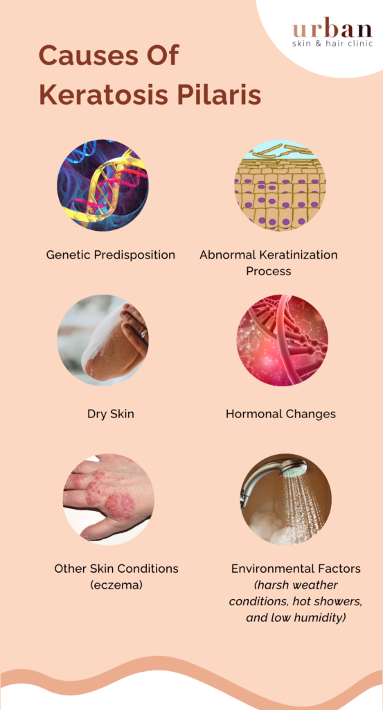 Causes Of Keratosis Pilaris