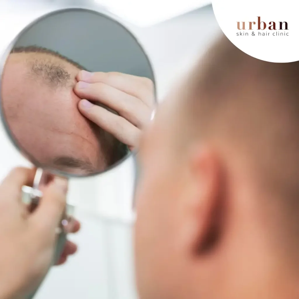Causes Of Male Pattern Baldness
