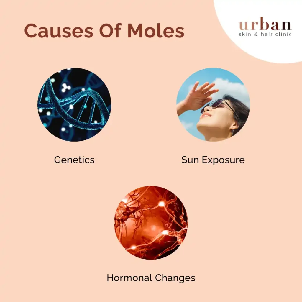 Causes Of Moles