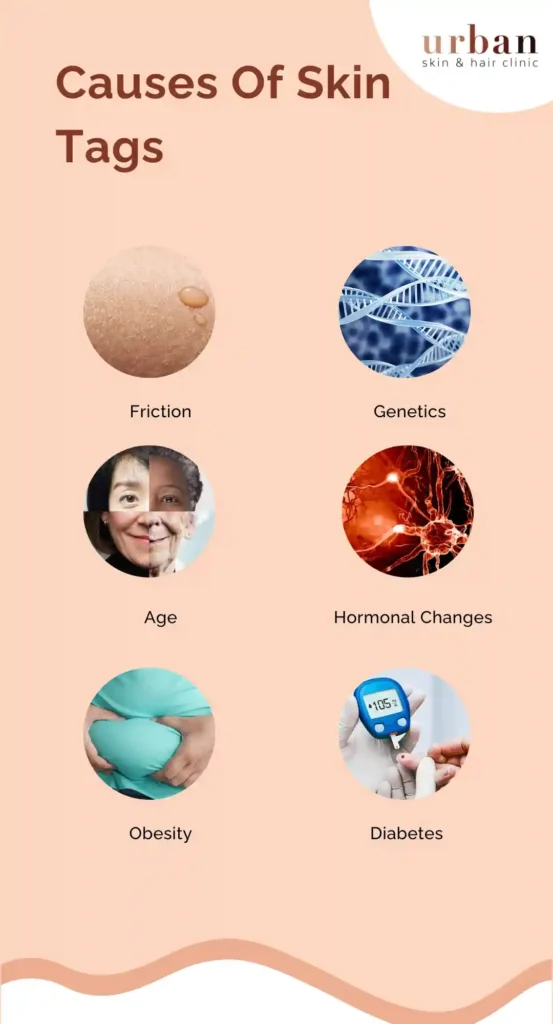 Skin Tags Types Causes Symptoms Treatment