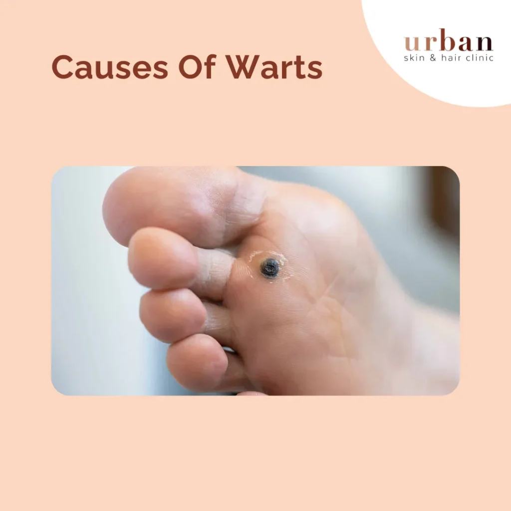 Causes Of Warts