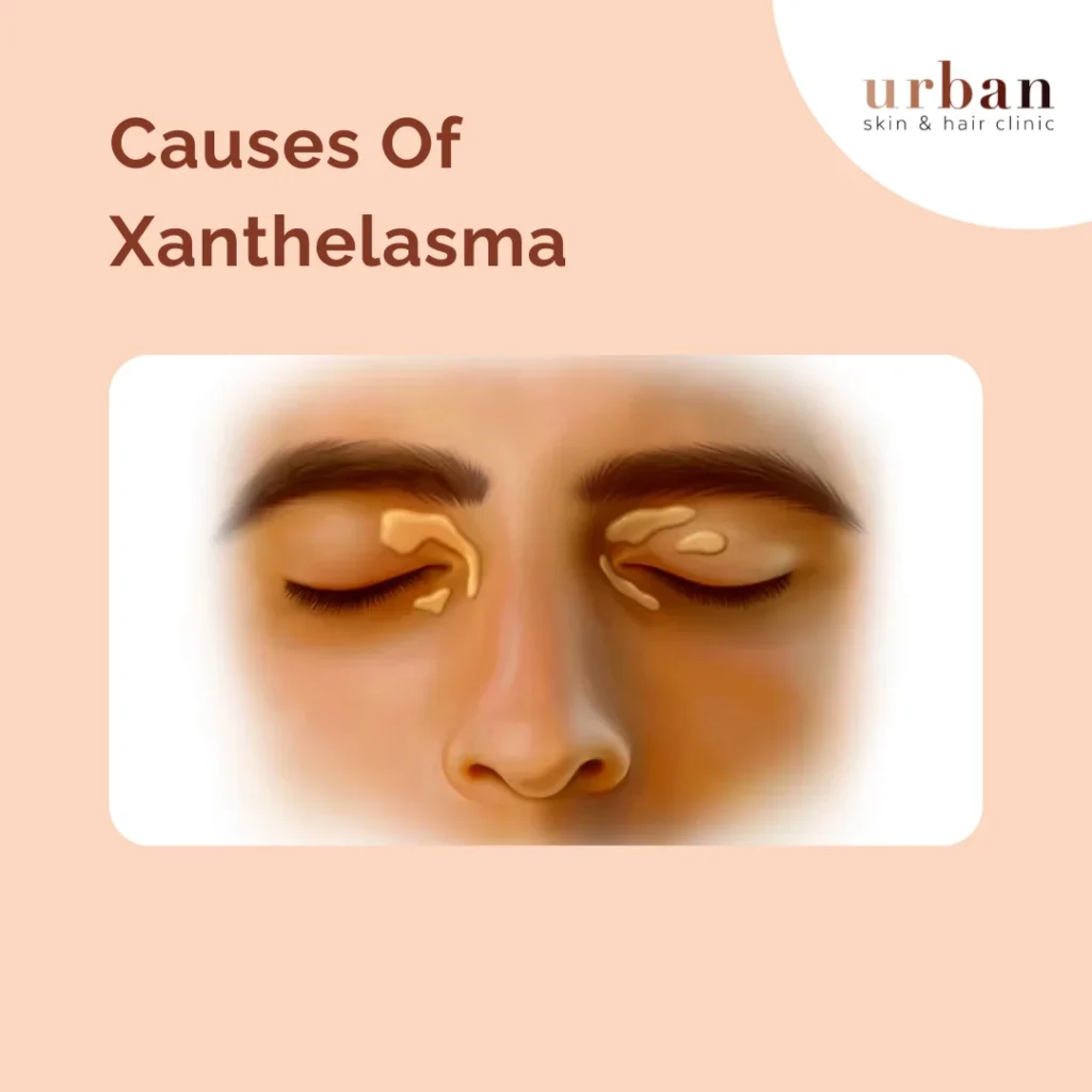 Causes Of Xanthelasma