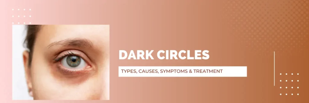 Dark Circles Types, Causes, Symptoms & Treatment