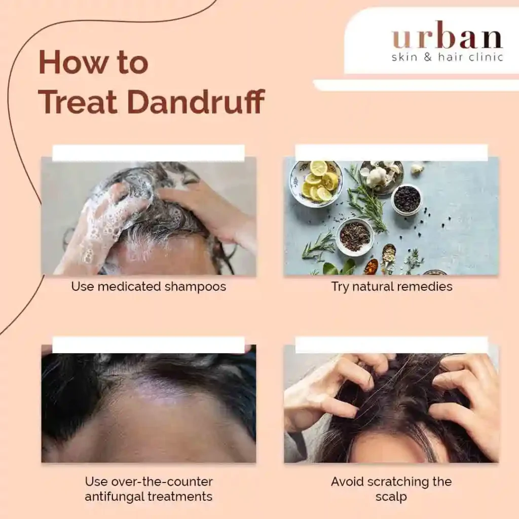 How to Treat Dandruff