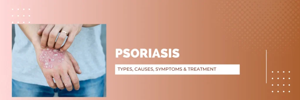 Psoriasis Vulgaris Types, Causes, Symptoms & Treatment