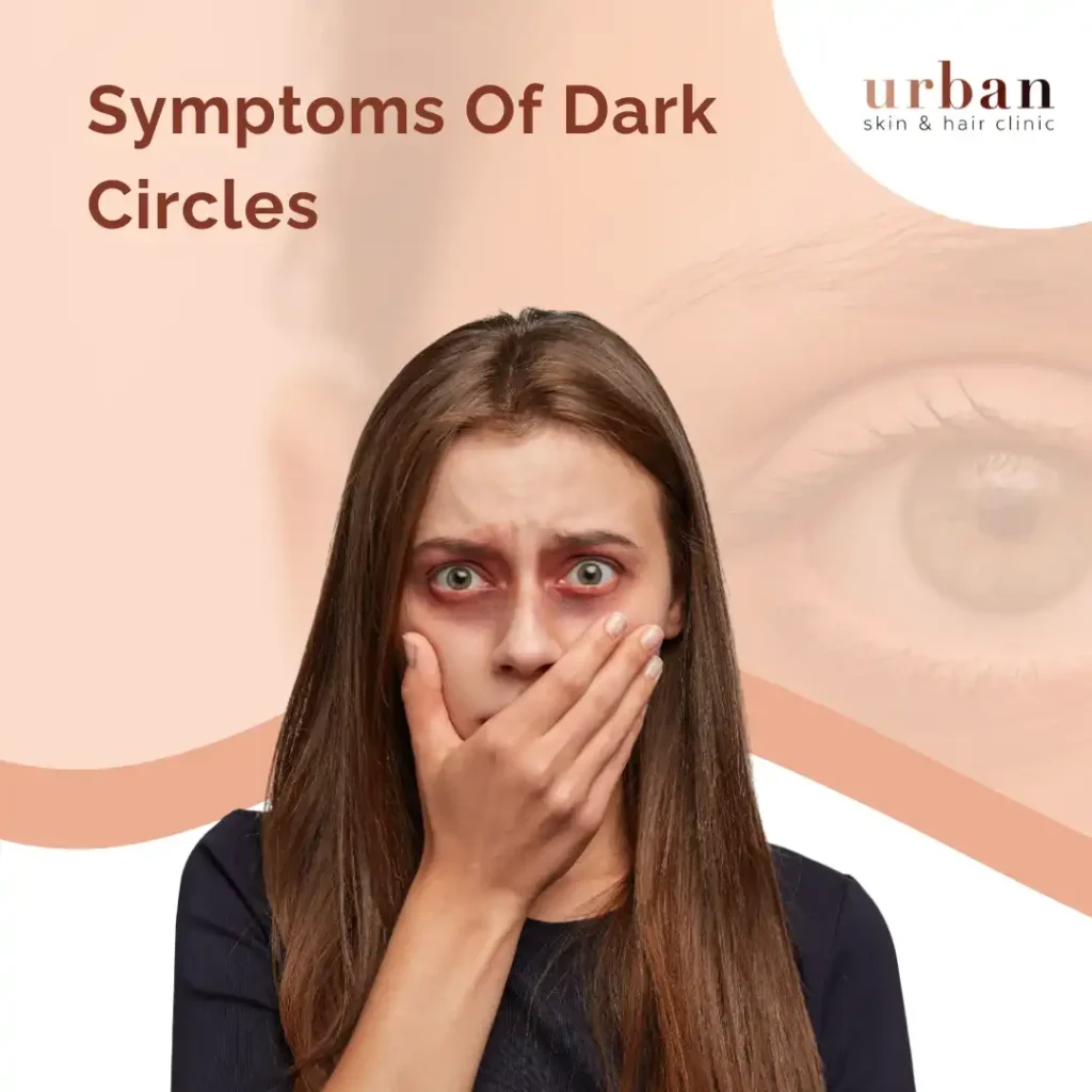 Symptoms Of Dark Circles