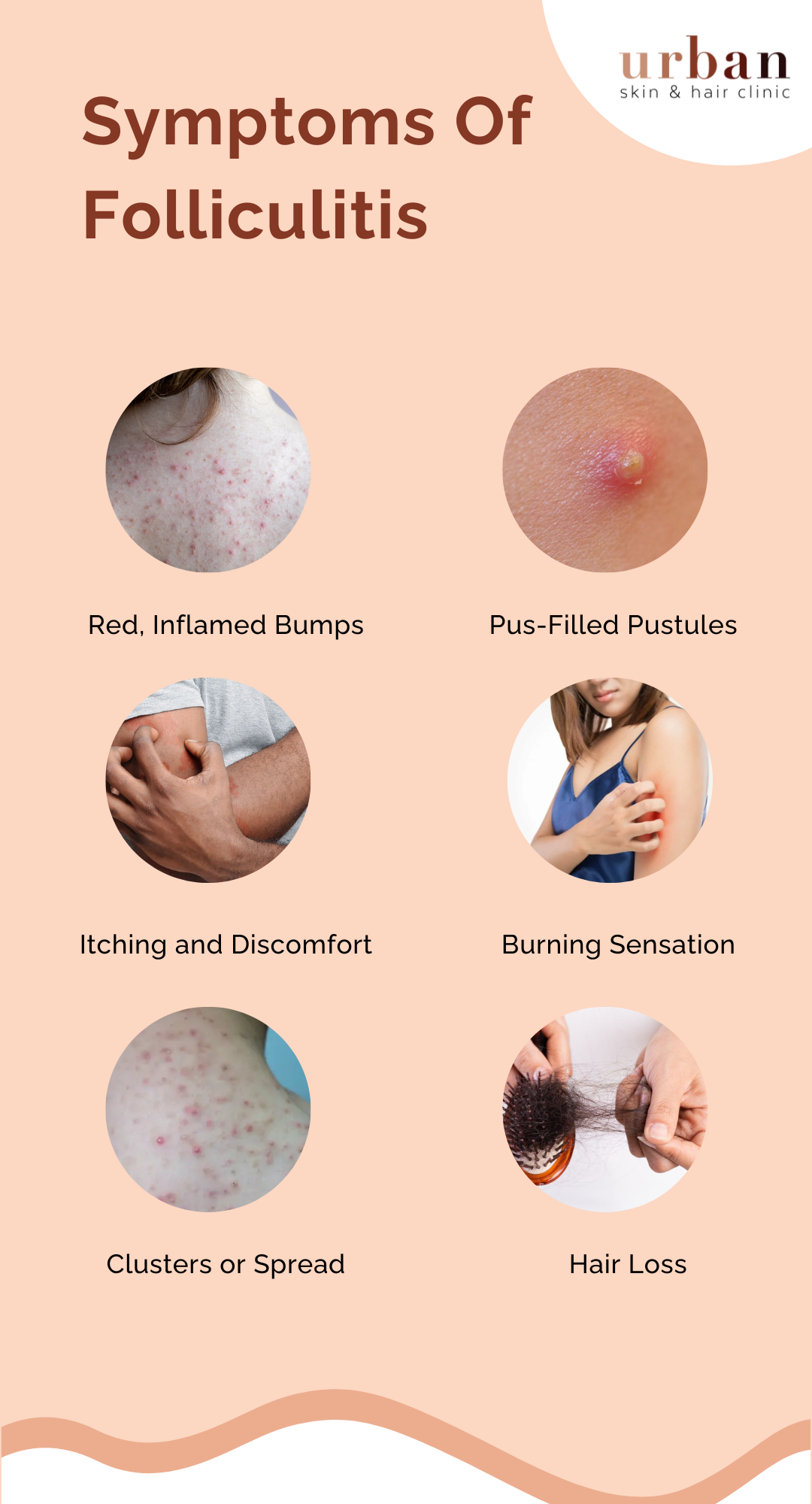 Folliculitis Types, Causes, Symptoms & Treatment | USHC