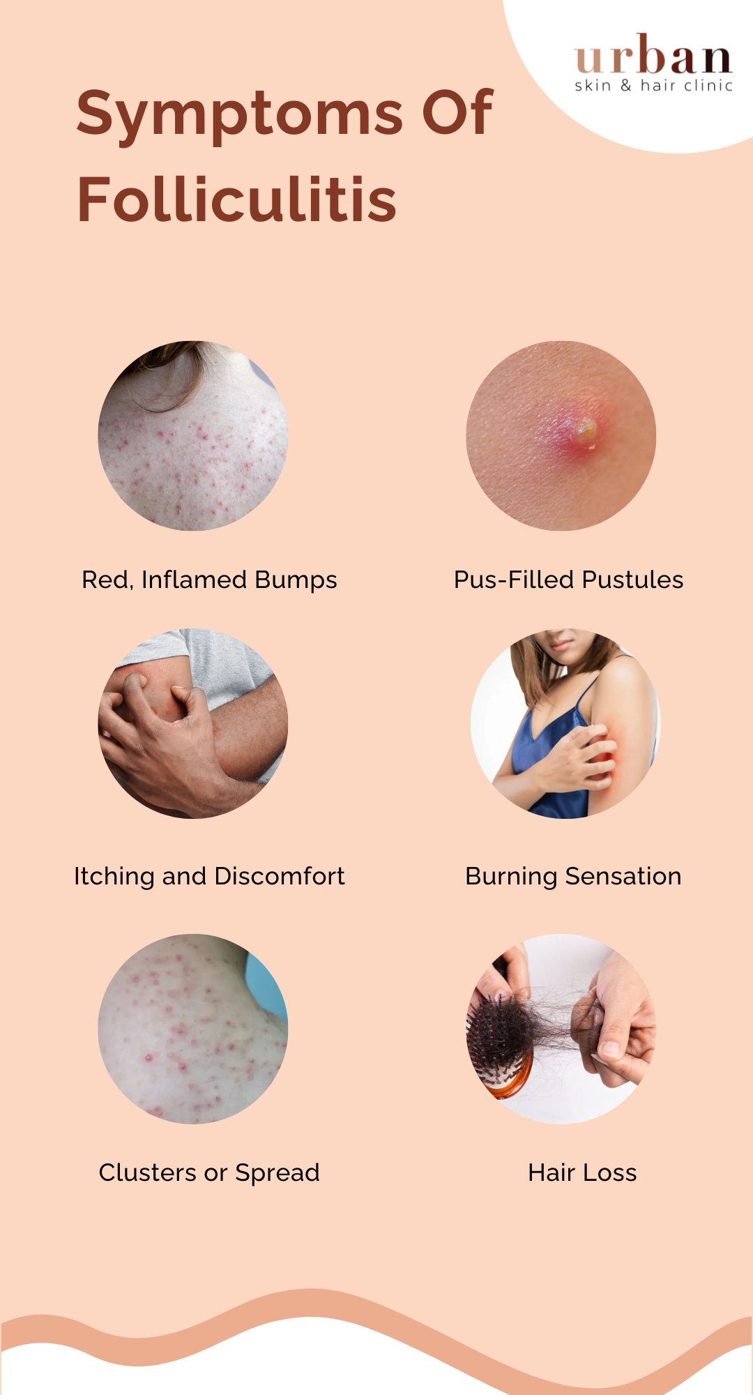 Scalp Folliculitis Symptoms Causes Diagnosis Treatment TIKFNK Scalp Folliculitis Symptoms Causes Diagnosis Treatment TIKFNK