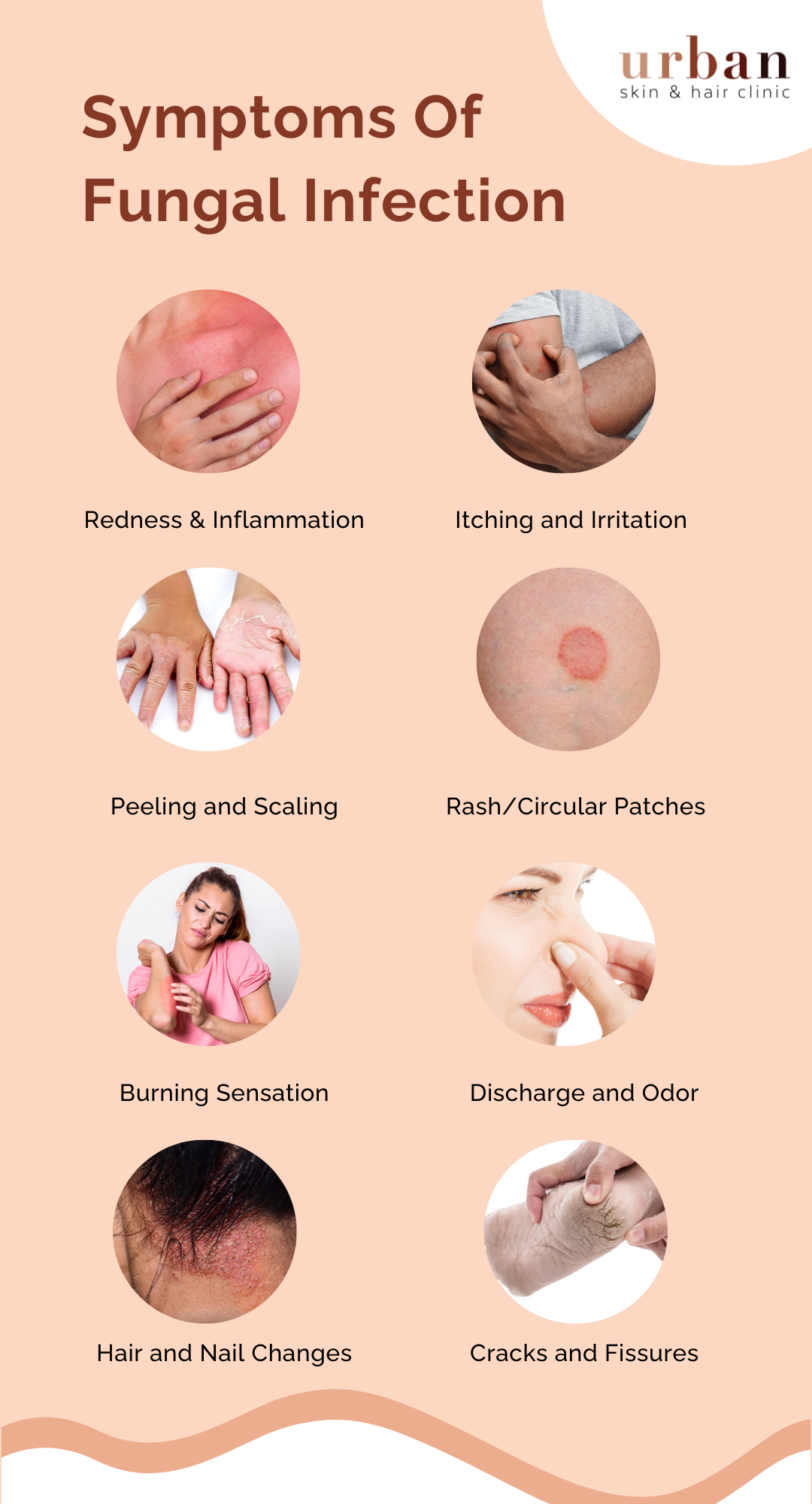 fungal-infection-types-causes-symptoms-treatment-ushc