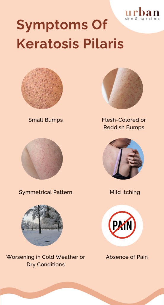 Hair Removal Keratosis Pilaris At Dean Metoyer Blog