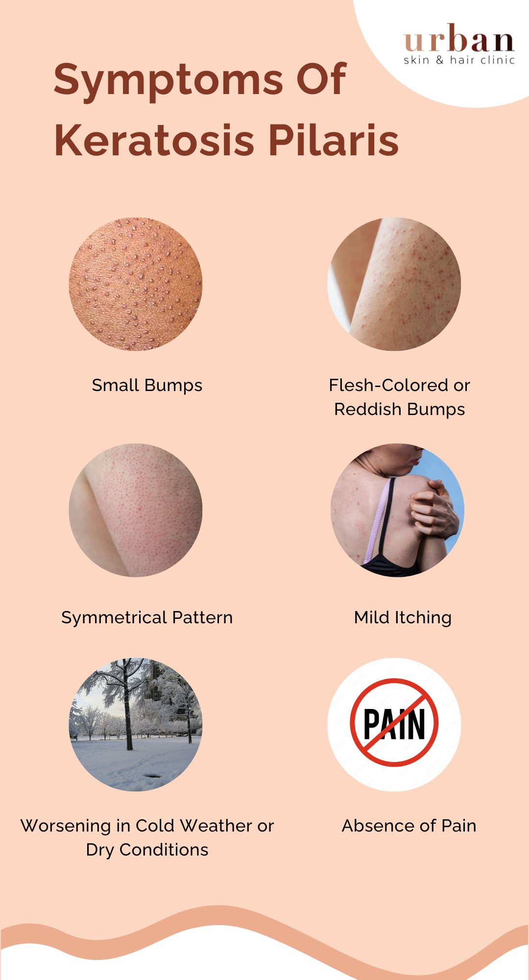 Keratosis Pilaris Causes, Symptoms & Treatment | USHC