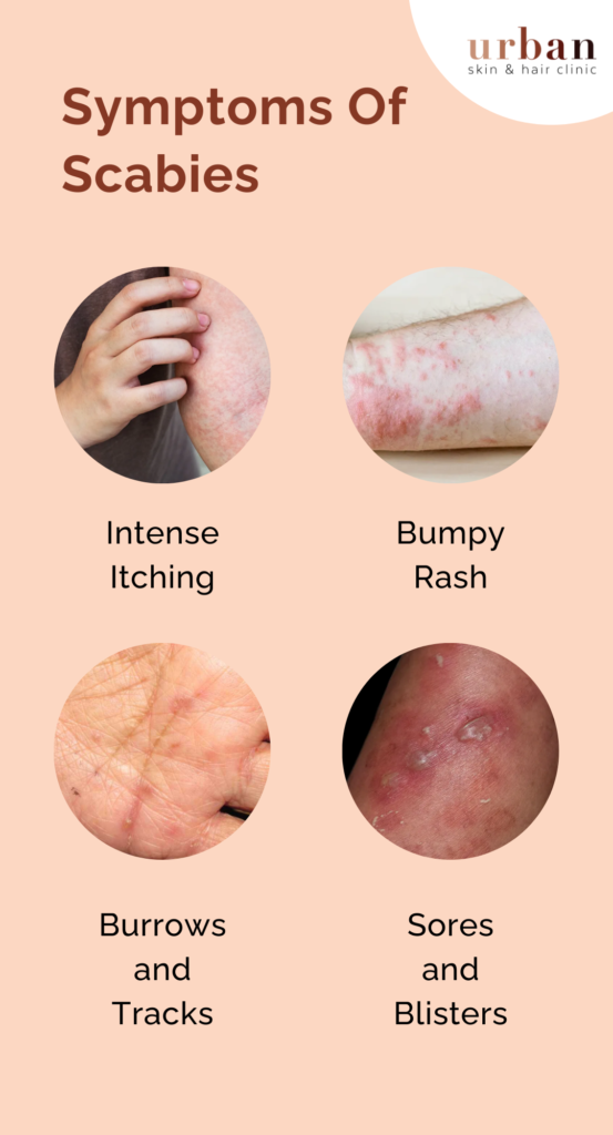 https://urbanskinhairclinic.com/wp-content/uploads/2023/08/Symptoms-Of-Scabies-553x1024.png