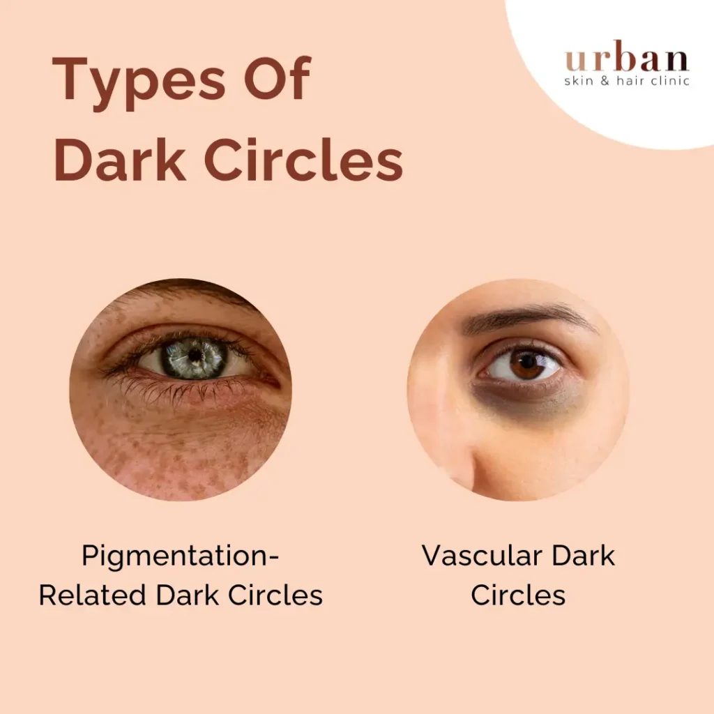 Types Of Dark Circles