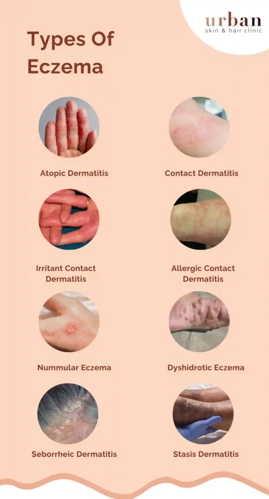 Types Of Eczema