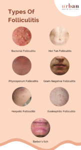 Folliculitis Types, Causes, Symptoms & Treatment | USHC