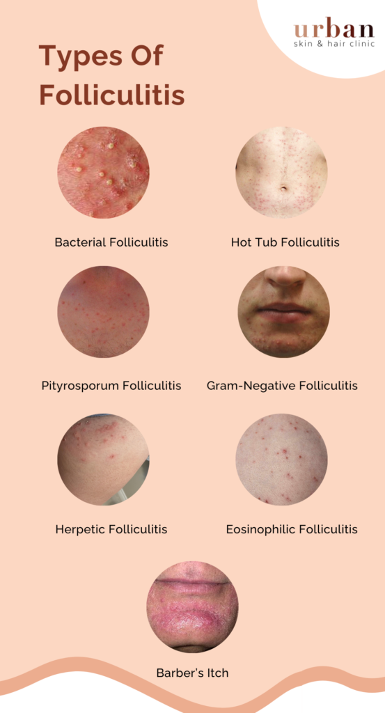 Types Of Folliculitis