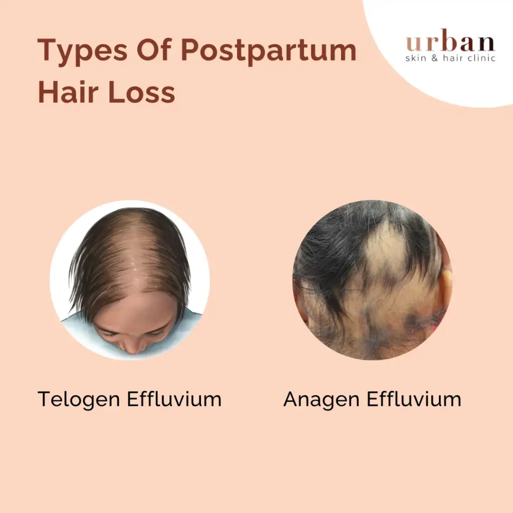 Types Of Postpartum Hair Loss