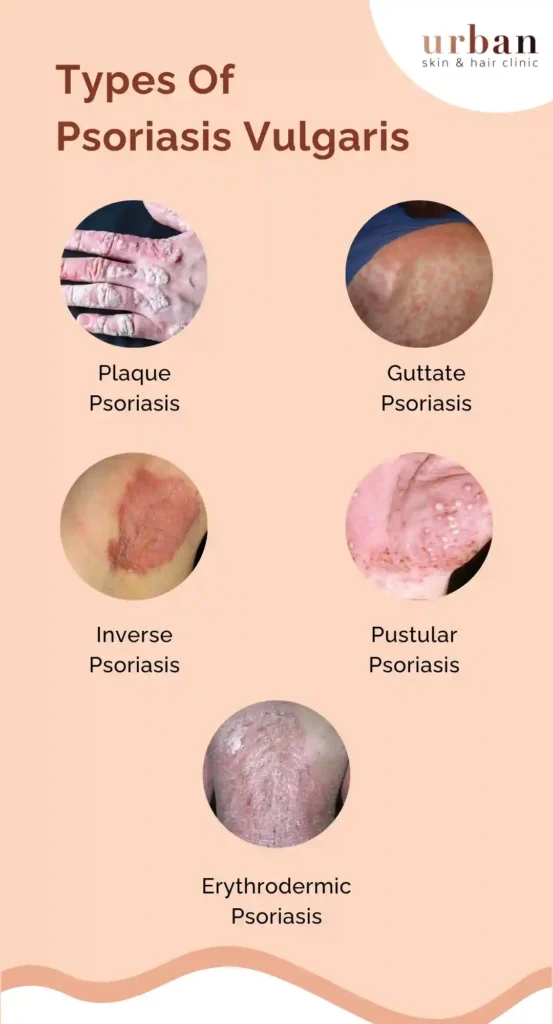 Types Of Psoriasis Vulgaris