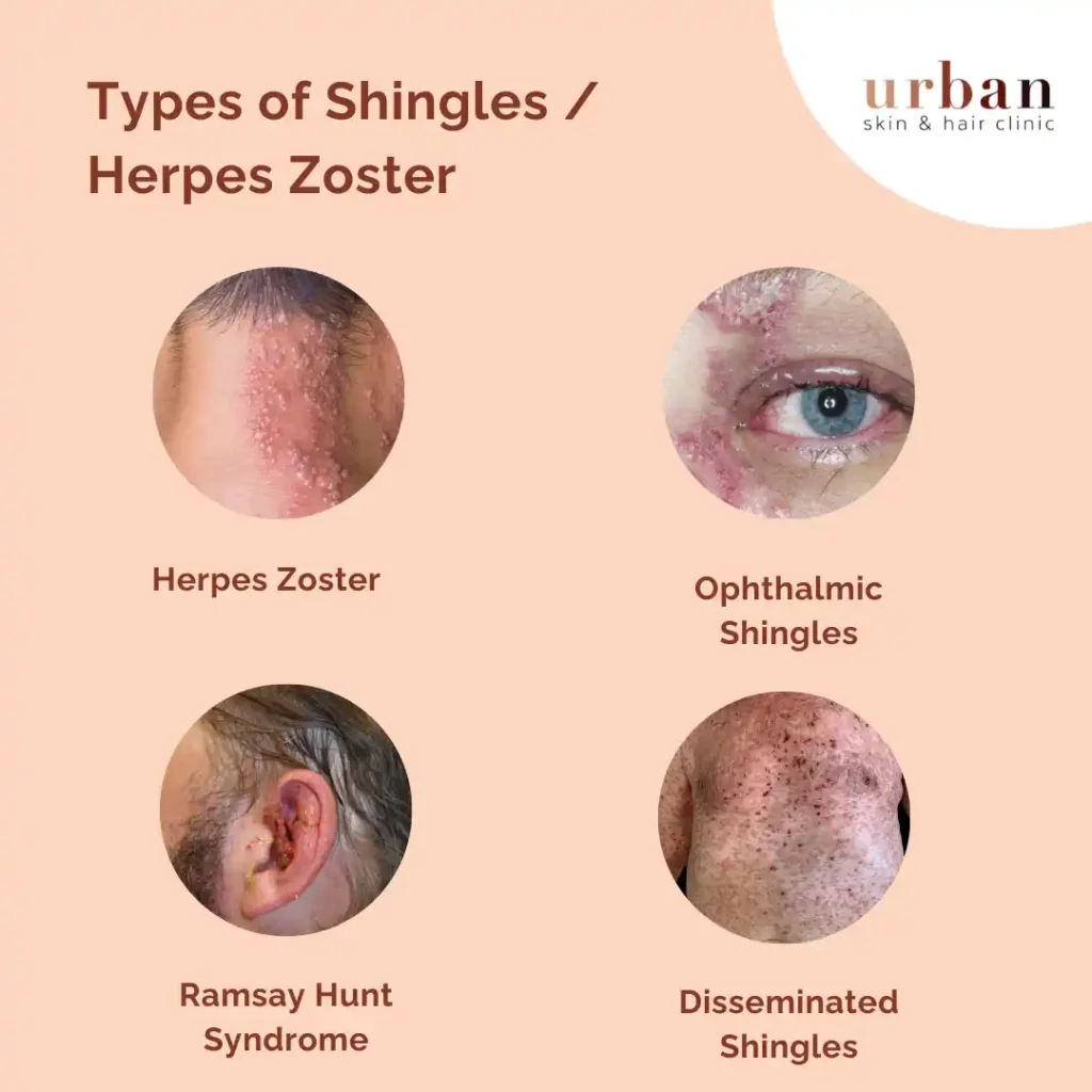 Herpes Zoster Types Causes And Symptoms 2026