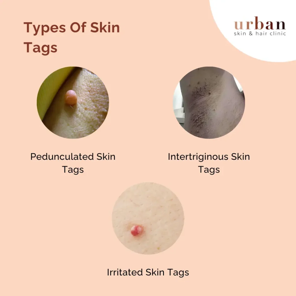 Medical Name For Skin Tag At David Morant Blog