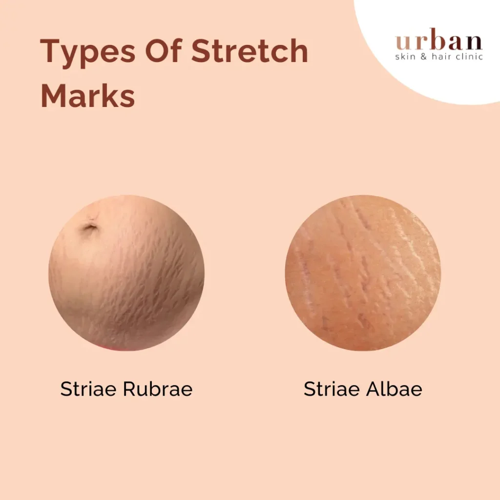 Stretch marks on breasts: Types, treatment options, and risk factors