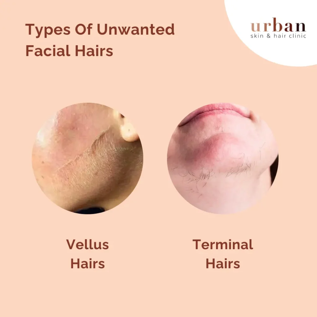 Types Of Unwanted Facial Hairs