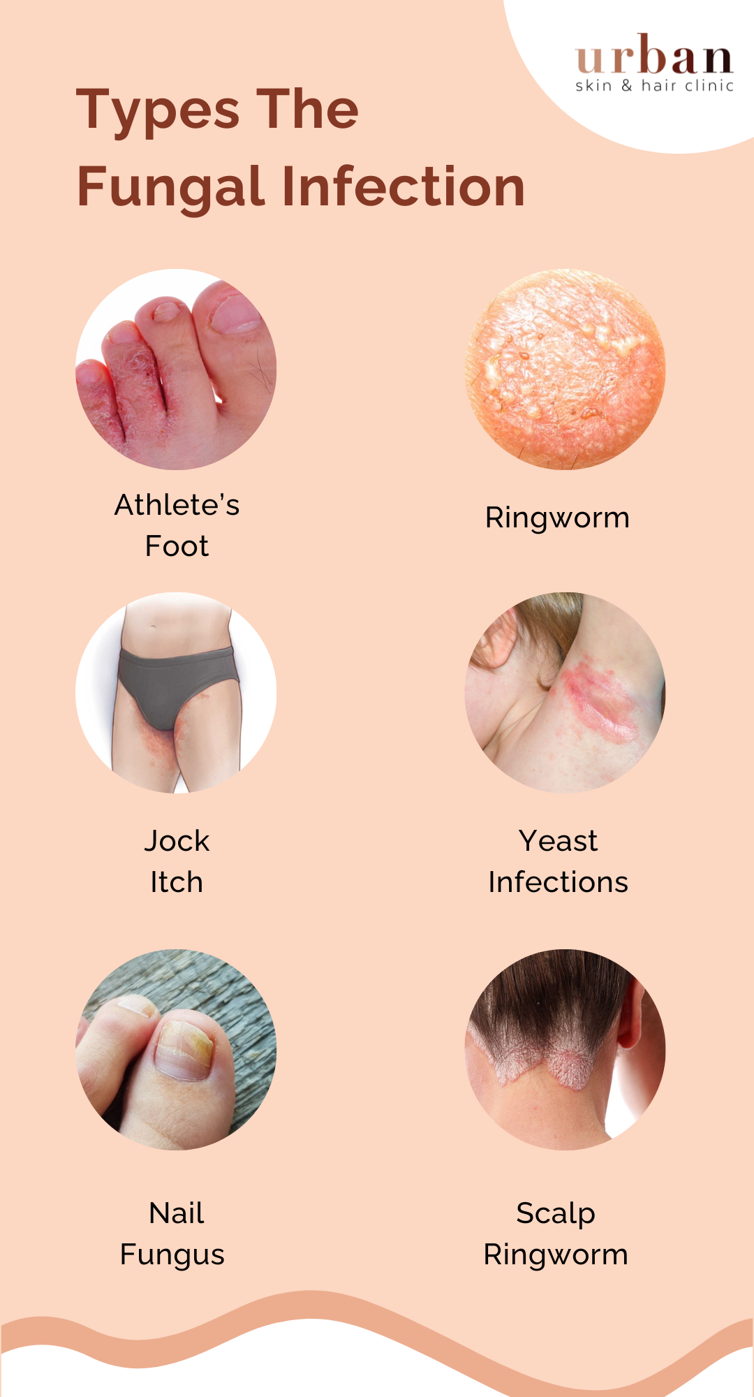 Fungal Infection Types Causes Symptoms And Treatment Ushc 3737