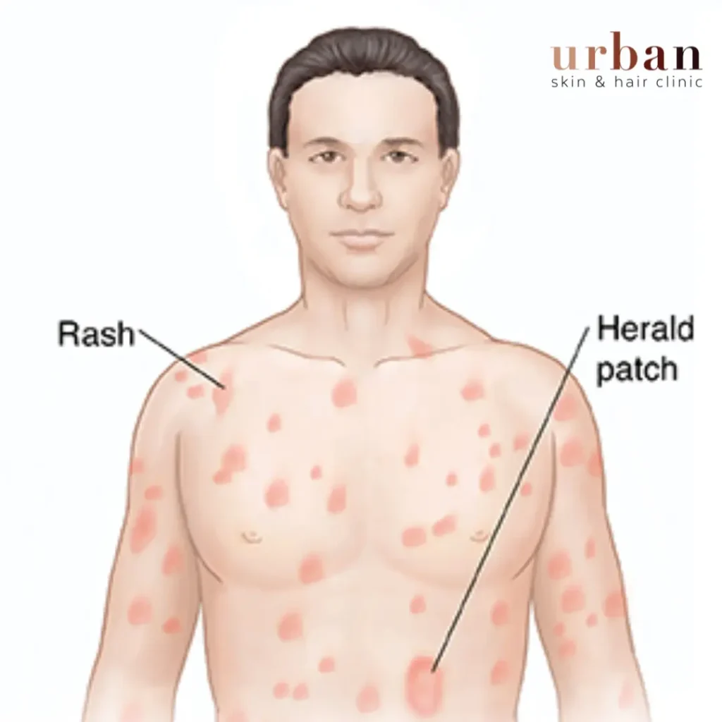 What Are The Types Of Pityriasis Rosea