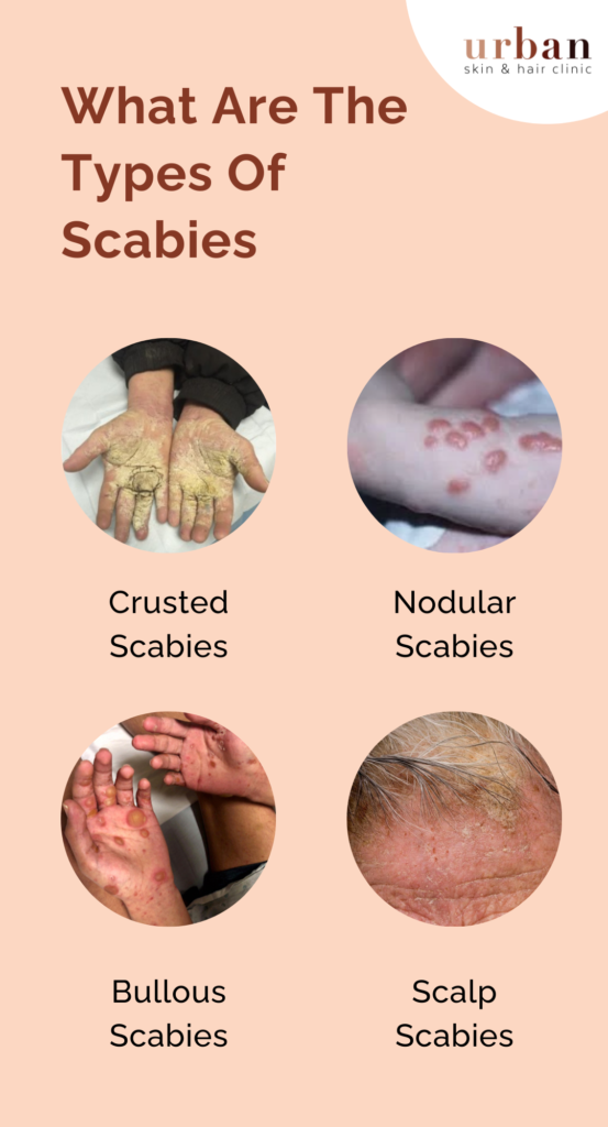 Scabies Types, Causes, Symptoms & Treatment