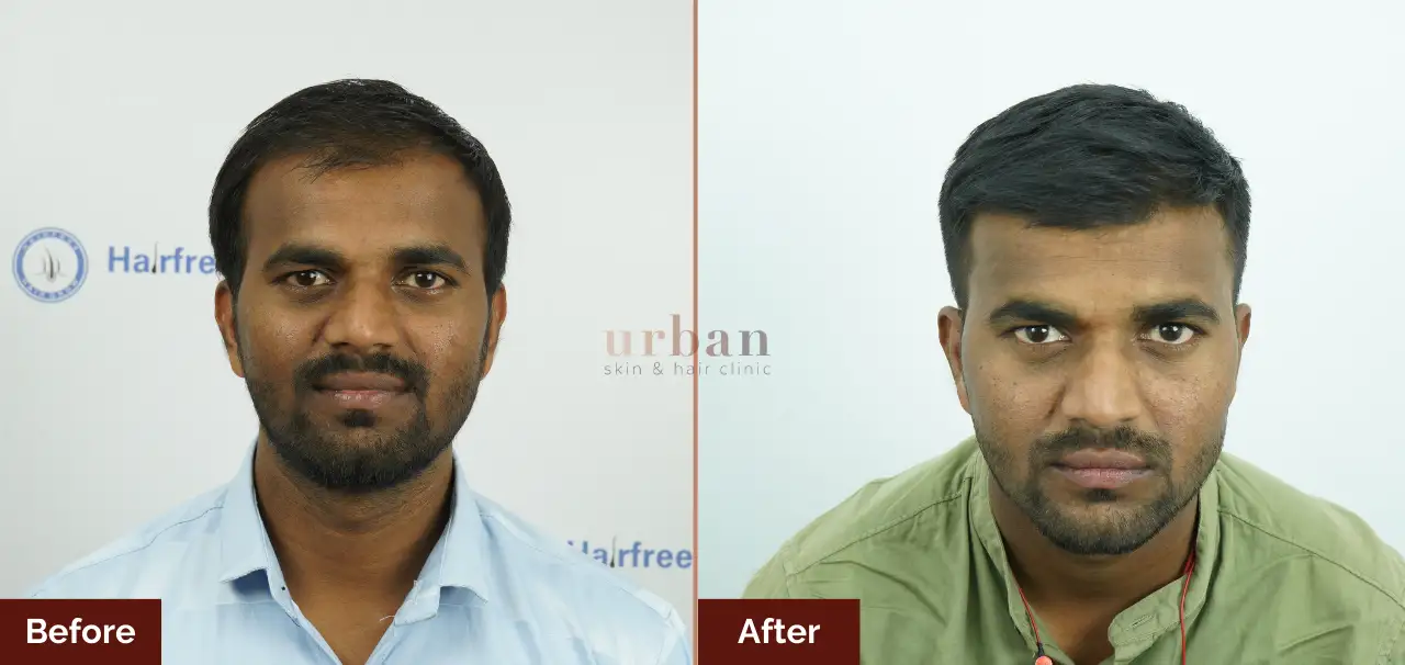 Homes 18 best male hair loss treatment in pune