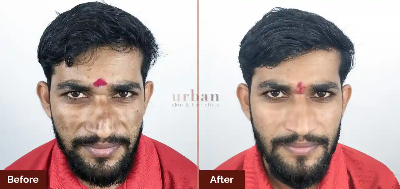 Homes 10 pigmentation treatment for male
