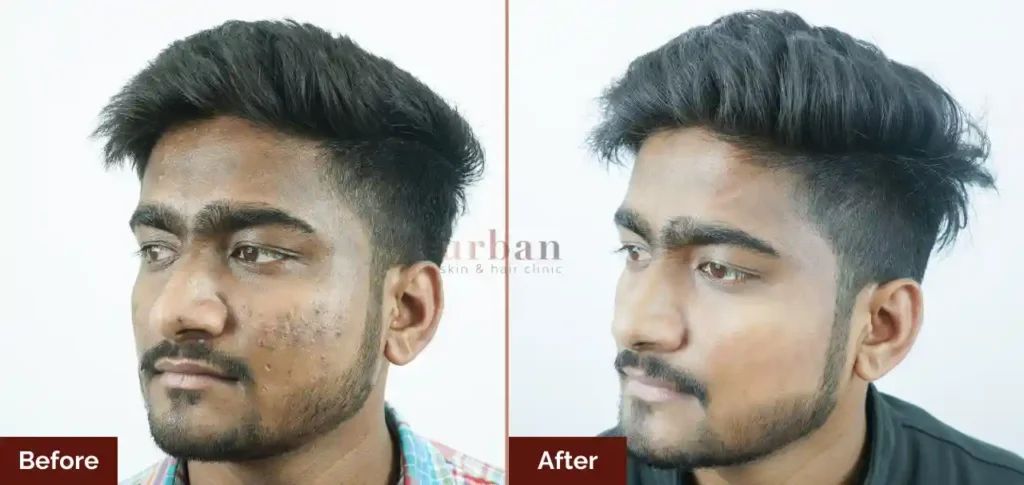 akash kakde pigmentation after before result