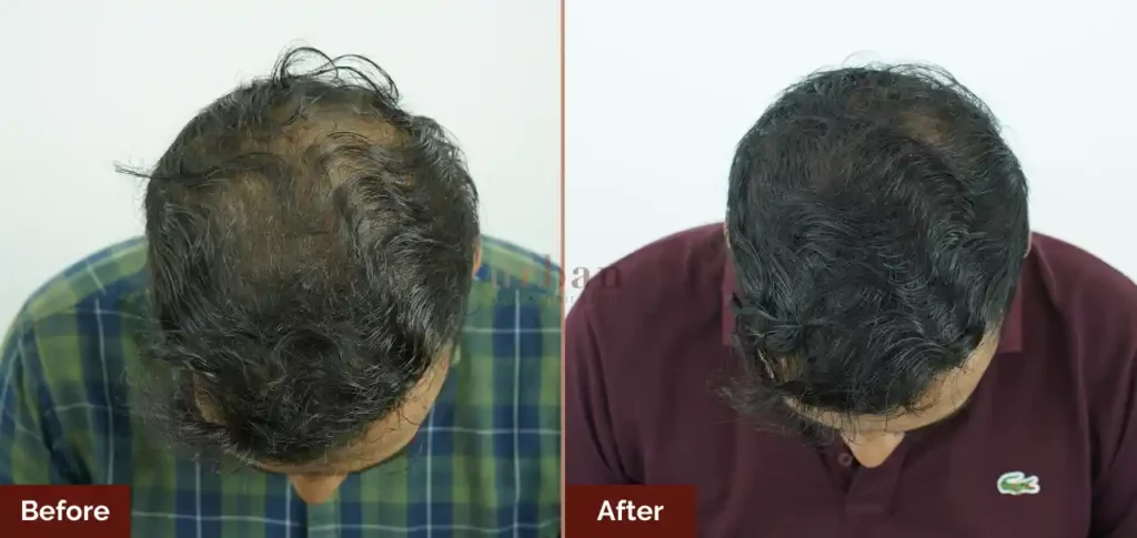 akshay shinde male hairloss after before result
