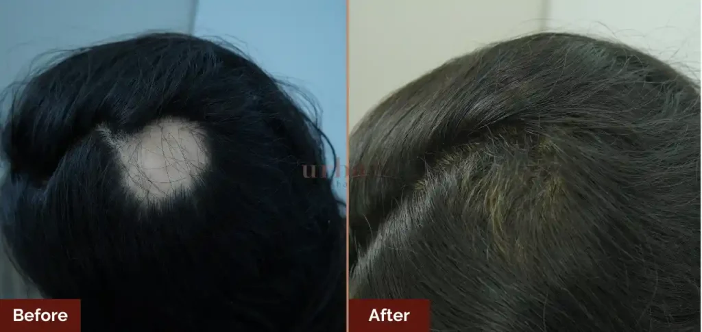 atiya shaikh female hairloss after before result