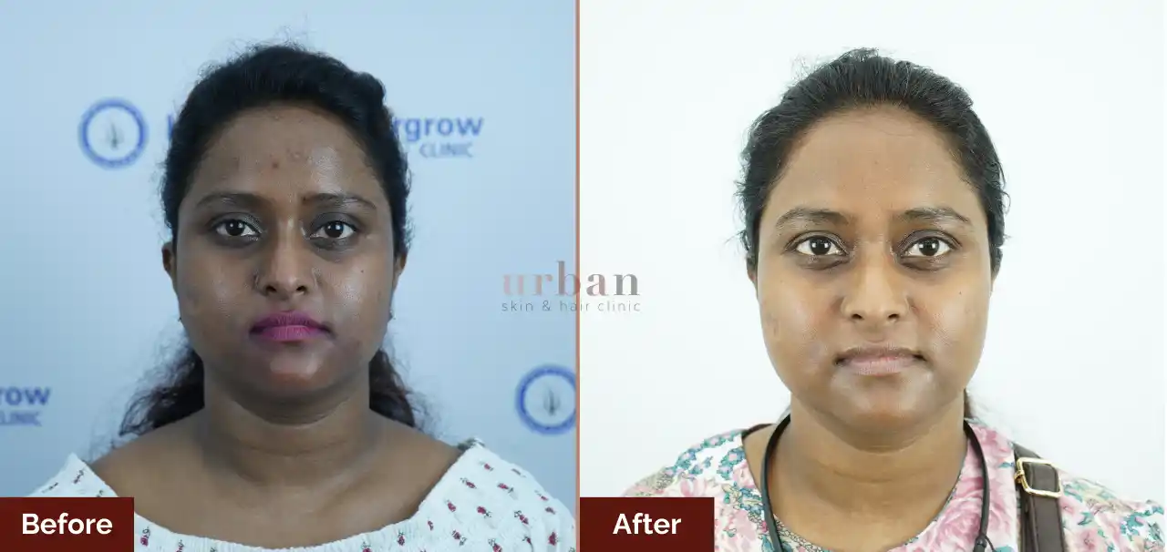 Homes 11 pigmentation treatment for female
