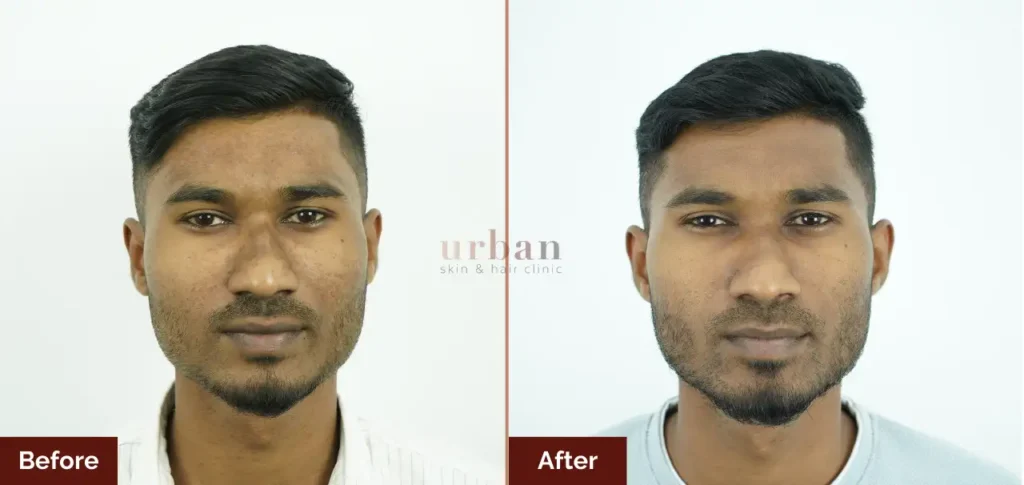 faisal tamboli pigmentation after before result