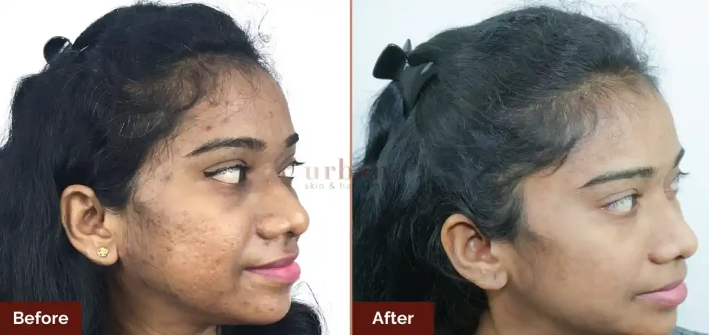 geeta waradkar acne + scar after before result