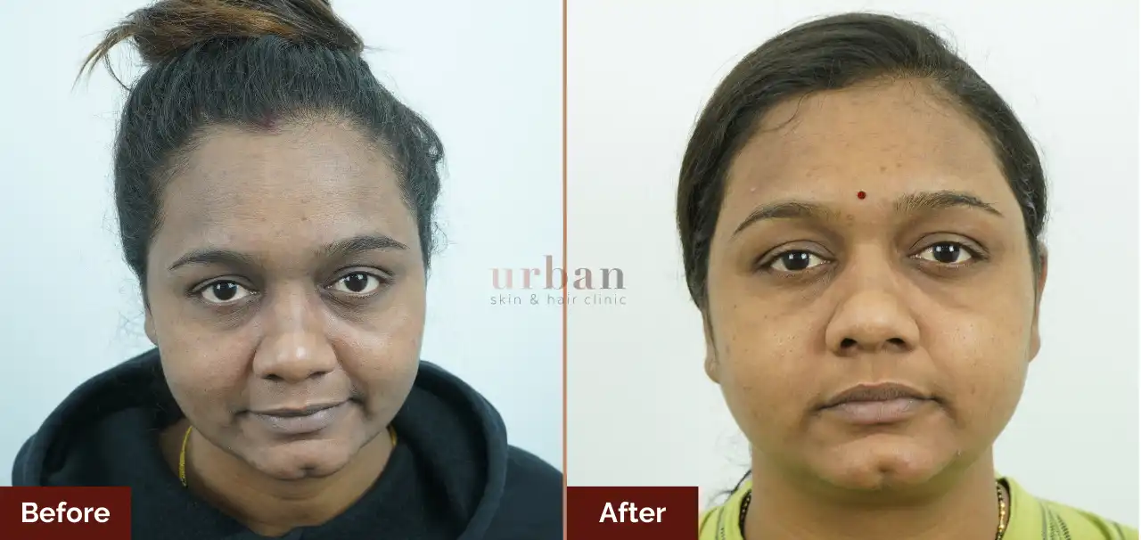 Homes 13 pigmentation female treatment