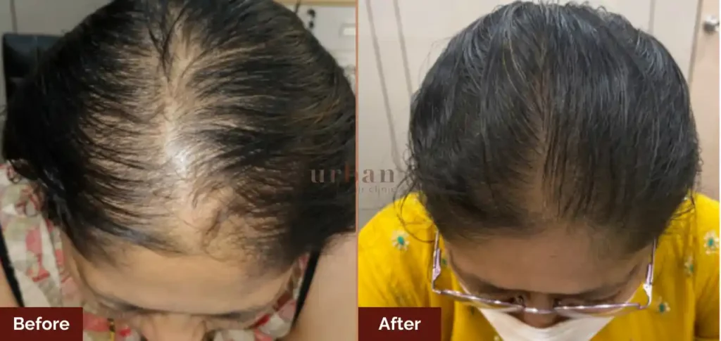 mansi salunke female hairloss after before result