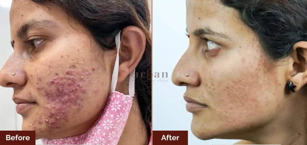 pranjali shitole acne after before result
